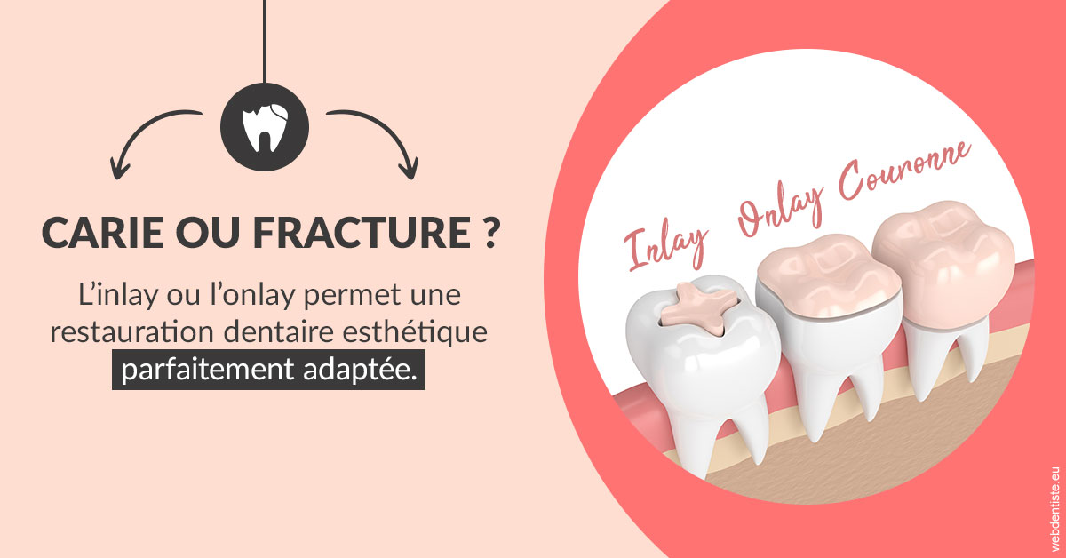 https://dr-salles-eric.chirurgiens-dentistes.fr/T2 2023 - Carie ou fracture 2