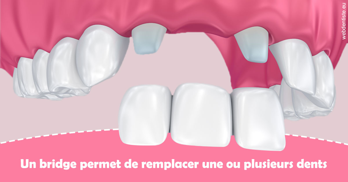 https://dr-salles-eric.chirurgiens-dentistes.fr/Bridge remplacer dents 2