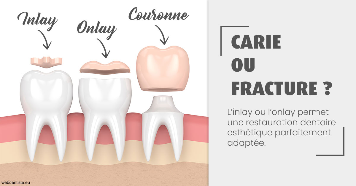 https://dr-salles-eric.chirurgiens-dentistes.fr/T2 2023 - Carie ou fracture 1