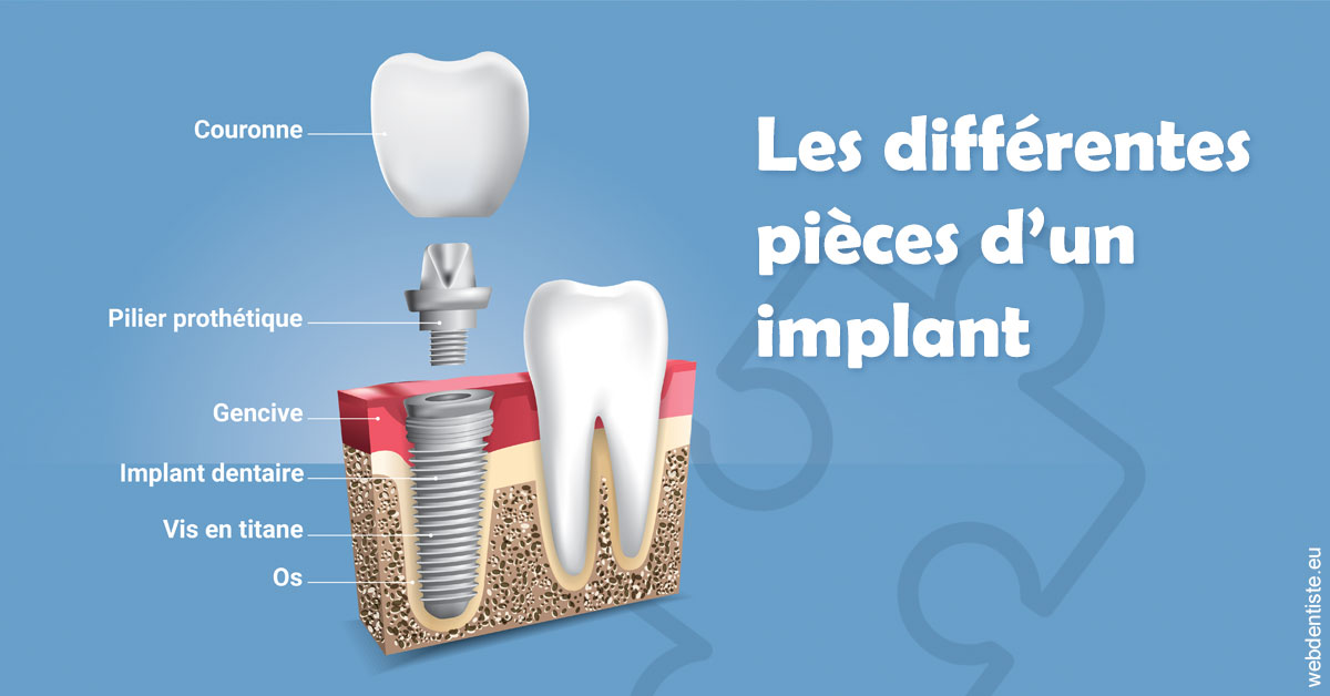 https://dr-salles-eric.chirurgiens-dentistes.fr/Les différentes pièces d’un implant 1
