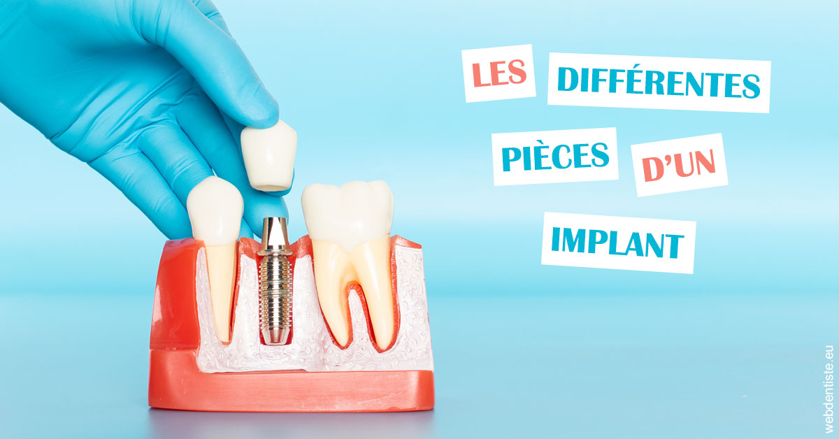 https://dr-salles-eric.chirurgiens-dentistes.fr/Les différentes pièces d’un implant 2